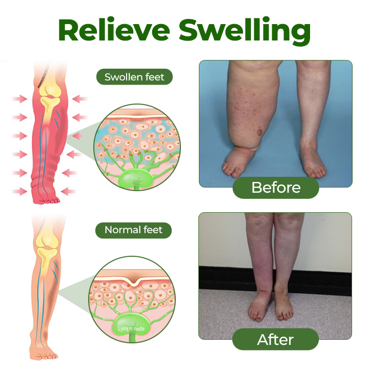 BBOJI® Professional Leg Circulation Cream-Clinically proven relief for swollen, heavy, painful legs.